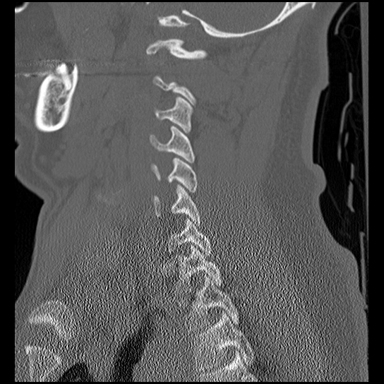 Atlanto-occipital dissociation injury (Radiopaedia 29274-29698 Sagittal bone window 40).png