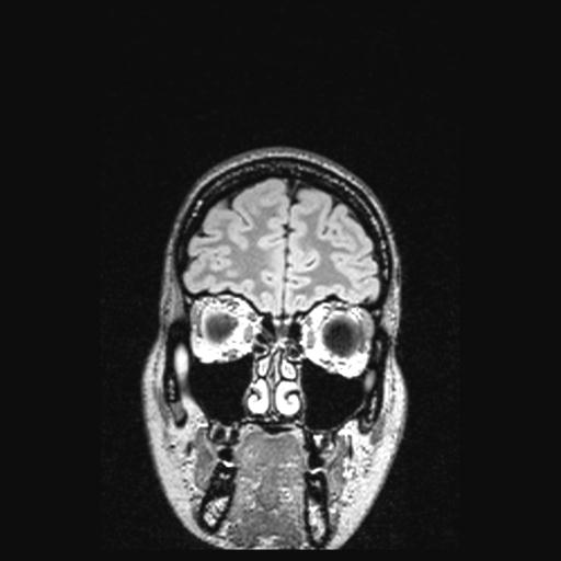 Atretic encephalocoele with inferior vermis hypoplasia (Radiopaedia 30443-31108 Coronal FLAIR 152).jpg