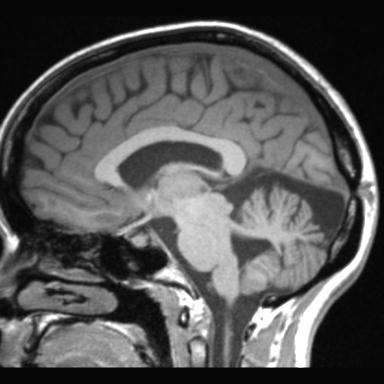 Atretic encephalocoele with inferior vermis hypoplasia (Radiopaedia 30443-31108 Sagittal T1 62).jpg