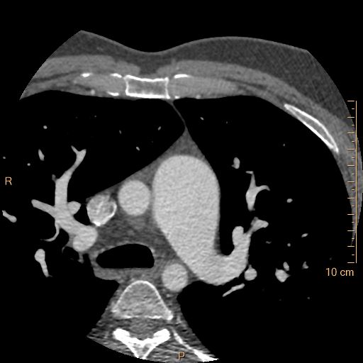 Atrial septal defect (upper sinus venosus type) with partial anomalous pulmonary venous return into superior vena cava (Radiopaedia 73228-83961 A 34).jpg
