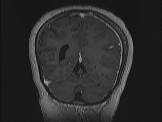 Atypical meningioma (Radiopaedia 62985-71406 Coronal T1 C+ 101).jpg