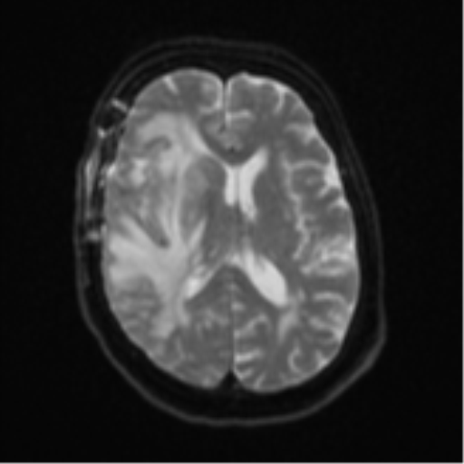 Atypical meningioma (WHO Grade II) (Radiopaedia 54742-60981 Axial DWI 16).png