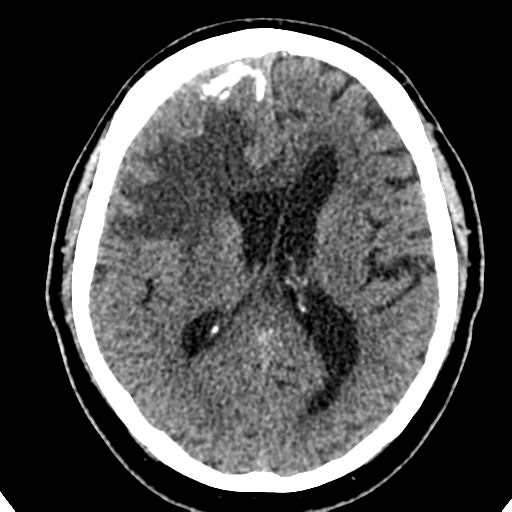 File:Atypical meningioma (WHO grade II) with brain invasion (Radiopaedia 57767-64728 Axial non-contrast 24).png