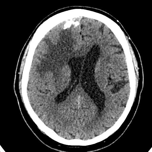 File:Atypical meningioma (WHO grade II) with brain invasion (Radiopaedia 57767-64728 Axial non-contrast 25).png