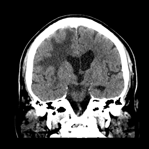 Atypical meningioma (WHO grade II) with brain invasion (Radiopaedia 57767-64728 Coronal C+ 32).png