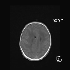 Atypical teratoid rhabdoid tumor (prenatal US and neonatal MRI) (Radiopaedia 59091-66388 Axial T1 44).jpg