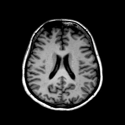 File:Autoimmune limbic encephalitis (Radiopaedia 30363-31005 T1 Axial 1mm 94).jpg