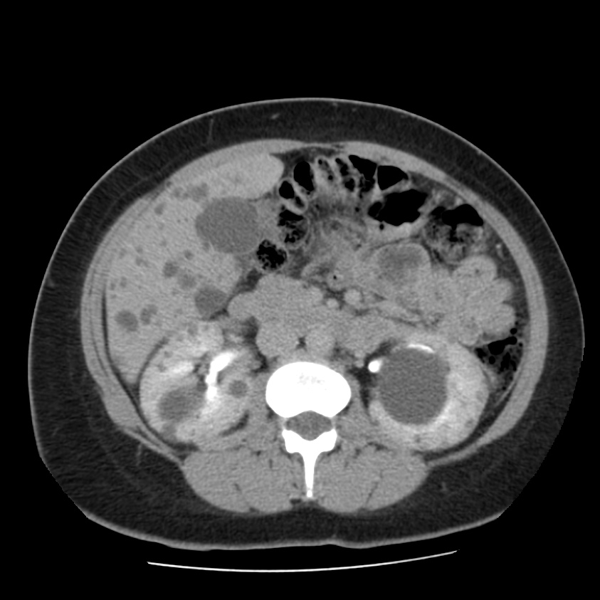 Autosomal dominant polycystic kidney disease (Radiopaedia 23061-23093 C+ delayed 30).jpg