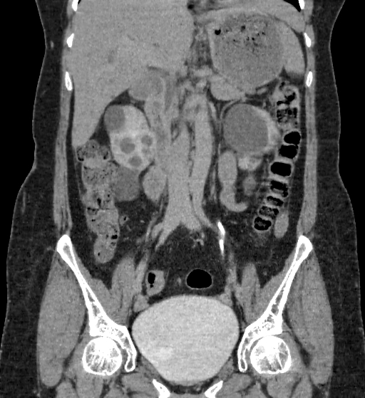 Autosomal dominant polycystic kidney disease (Radiopaedia 38189-40194 Coronal C+ delayed 39).jpg