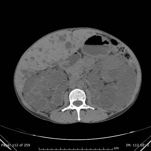 File:Autosomal dominant polycystic kidney disease (Radiopaedia 44122-47684 Axial 15).jpg