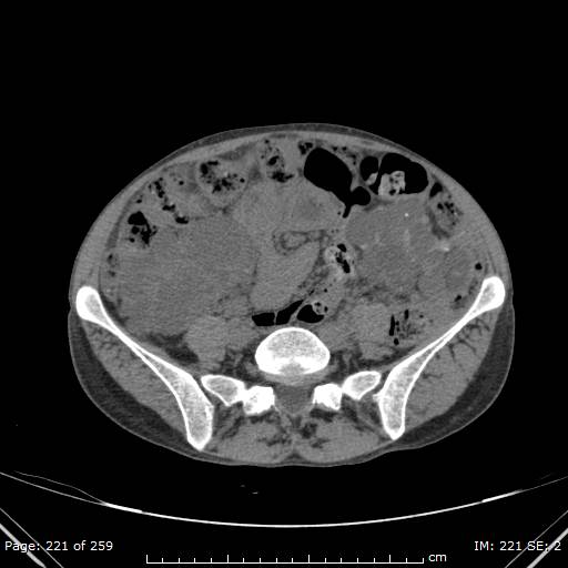 File:Autosomal dominant polycystic kidney disease (Radiopaedia 44122-47684 Axial 64).jpg