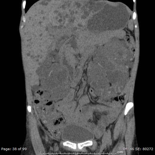 File:Autosomal dominant polycystic kidney disease (Radiopaedia 44122-47684 Coronal 11).jpg