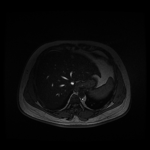 File:Autosomal dominant polycystic kidney disease (Radiopaedia 50259-55611 Axial 2D Dual Echo 15).jpg