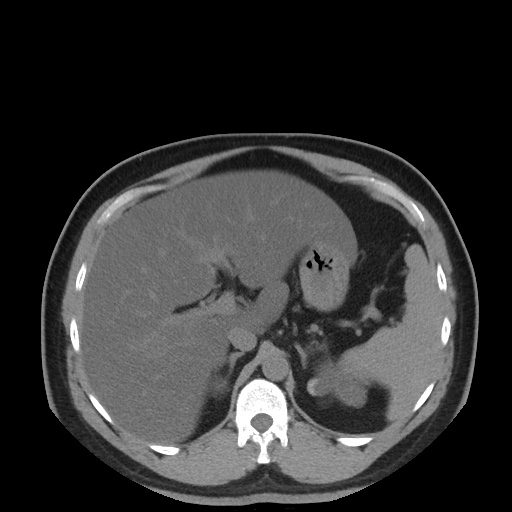 Autosomal dominant polycystic kidney disease (Radiopaedia 50259-55612 Axial non-contrast 25).jpg