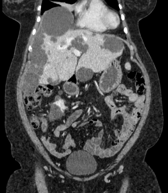 Autosomal dominant polycystic kidney disease (Radiopaedia 57124-64017 B 25).jpg