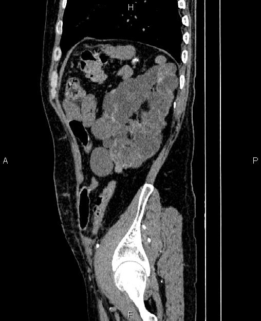 Autosomal dominant polycystic kidney disease (Radiopaedia 87830-104287 C 74).jpg
