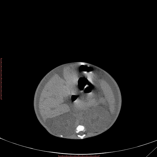 Autosomal recessive polycystic kidney disease associated with Caroli disease (Radiopaedia 61932-69984 Axial non-contrast 180).jpg