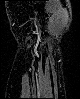 Avascular necrosis of the capitate (Radiopaedia 88317-104948 Coronal T1 vibe 83).jpg
