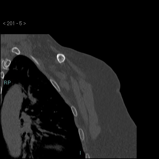 Avascular necrosis of the shoulder - Cruess stage I (Radiopaedia 77674-89887 Coronal bone window 4).jpg