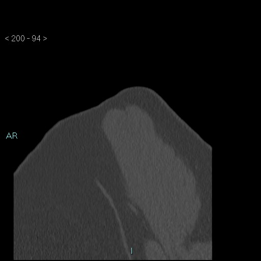 Avascular necrosis of the shoulder - Cruess stage I (Radiopaedia 77674-89887 Sagittal bone window 93).jpg