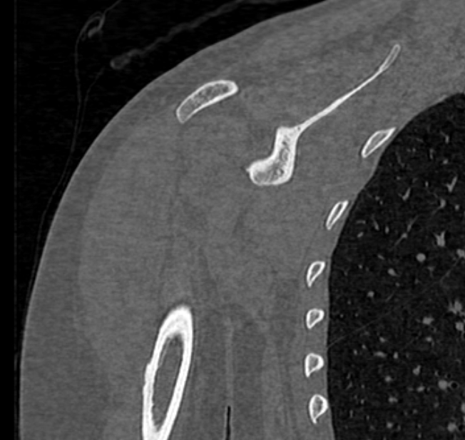 Avulsion fracture - greater tuberosity of humerus (Radiopaedia 71216-81514 Coronal bone window 42).jpg