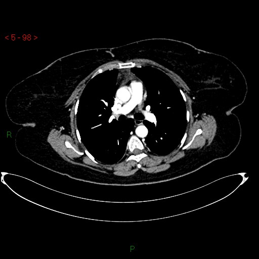 Azygos fissure and lobe (Radiopaedia 47620-52278 A 84).jpg