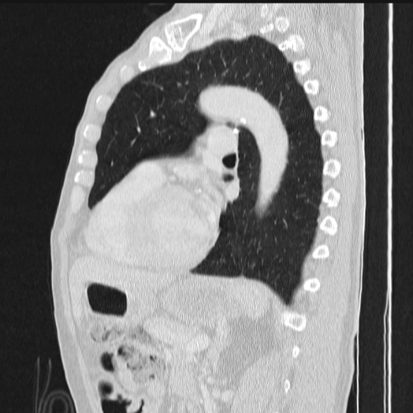 Azygos lobe (Radiopaedia 38259-40275 lung window 61).jpg