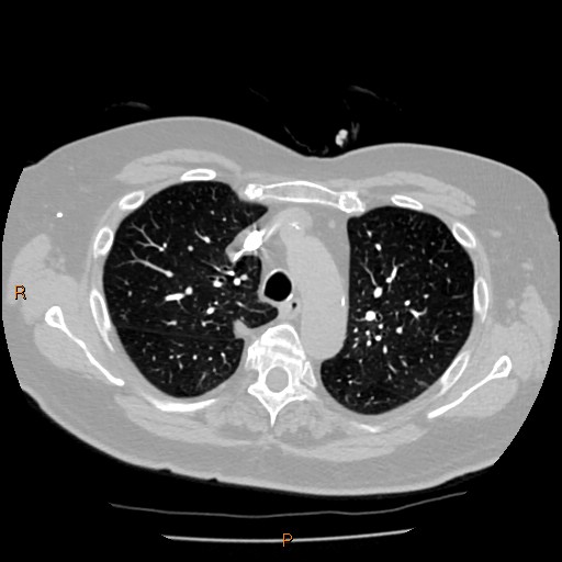 Azygos lobe (Radiopaedia 40161-42821 Axial lung window 19).jpg