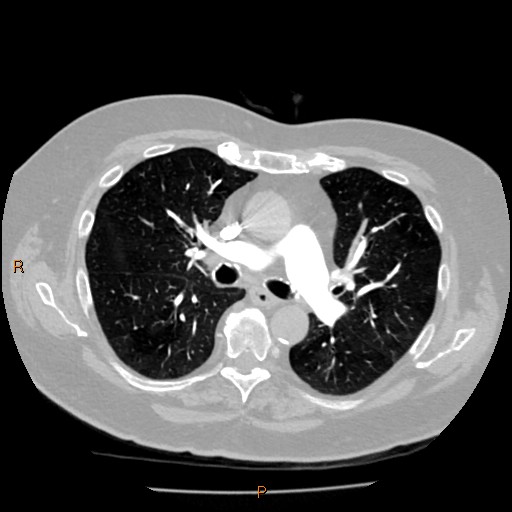 Azygos lobe (Radiopaedia 40161-42821 Axial lung window 29).jpg