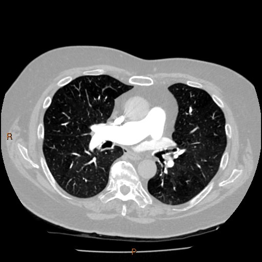 Azygos lobe (Radiopaedia 40161-42821 Axial lung window 34).jpg