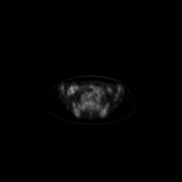 B-cell lymphoma of the mesentery (Radiopaedia 65743-74868 18F-FDG PET-CT 102).jpg
