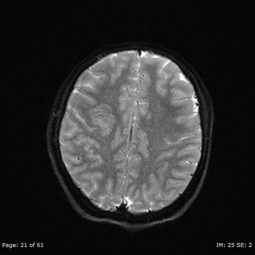 Balo concentric sclerosis (Radiopaedia 61637-69636 I 145).jpg