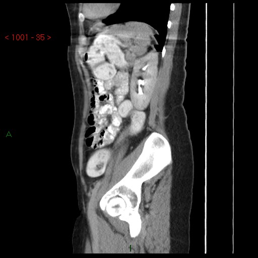 File:Bartholin gland cyst (Radiopaedia 54904-61181 Sagittal C+ delayed 35).jpg