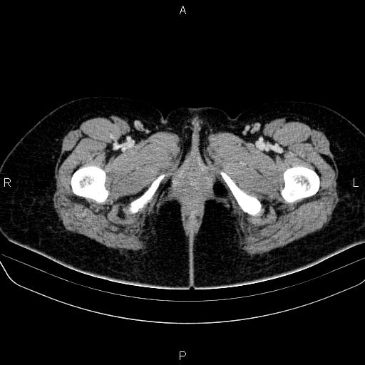 File:Bartholin gland cyst (Radiopaedia 62635-70930 Axial Post contrast 96).jpg