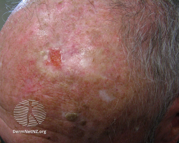 File:Basal cell carcinoma affecting the face (DermNet NZ lesions-bcc-face-0668).jpg