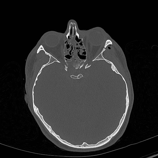 File:Base of skull fracture with bilateral Le Fort fractures (Radiopaedia 47094-51638 Axial bone window 40).jpg