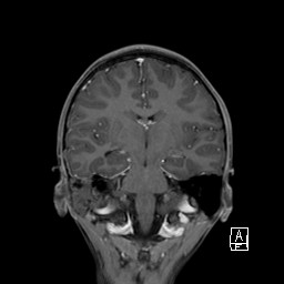 Base of skull rhabdomyosarcoma (Radiopaedia 32196-33142 I 42).jpg