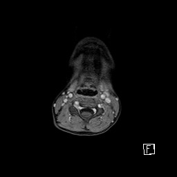 Base of skull rhabdomyosarcoma (Radiopaedia 32196-33142 T1 C+ fat sat 1).jpg