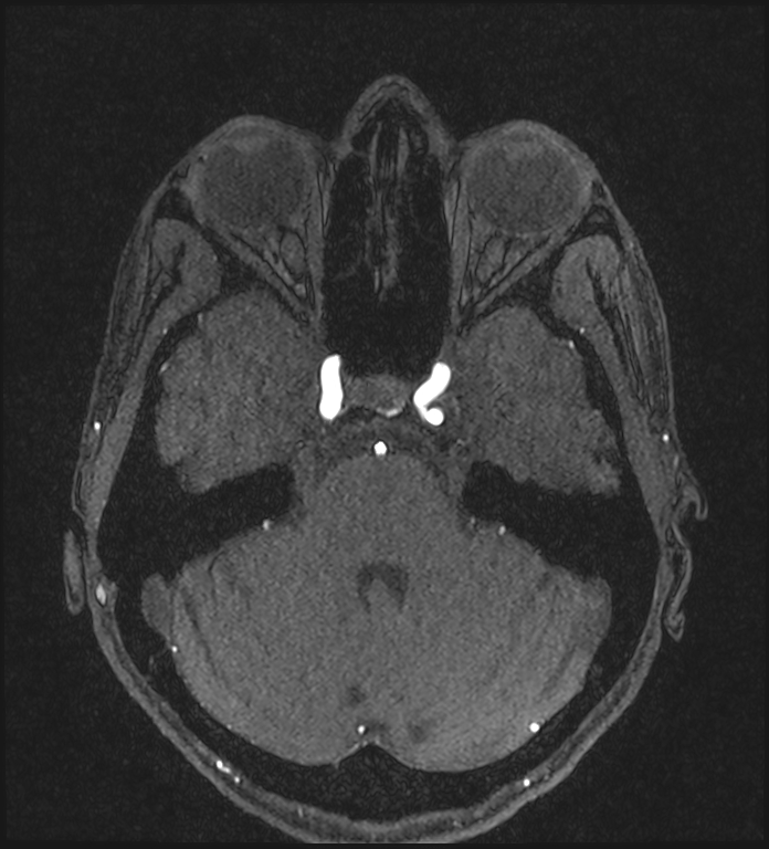 Basilar artery perforator aneurysm (Radiopaedia 82455-97733 Axial MRA 78).jpg