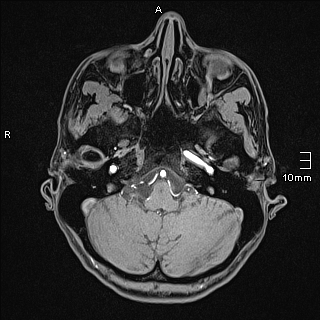 Basilar artery perforator aneurysm (Radiopaedia 82455-99523 F 19).jpg