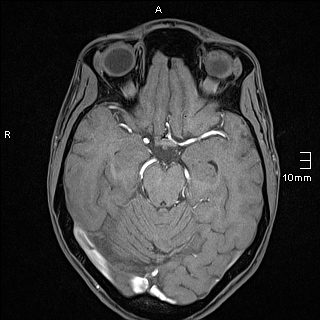 Basilar artery perforator aneurysm (Radiopaedia 82455-99523 F 53).jpg