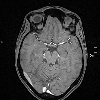 Basilar artery perforator aneurysm (Radiopaedia 82455-99523 F 55).jpg