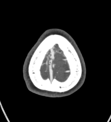 File:Basilar tip aneurysm with coiling (Radiopaedia 53912-60086 A 142).jpg