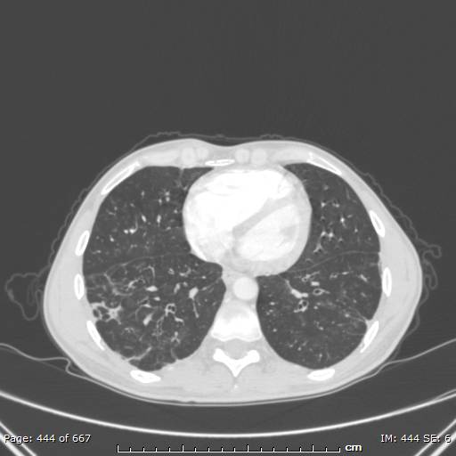 File:Behçet disease (Radiopaedia 44247-47889 Axial lung window 60).jpg