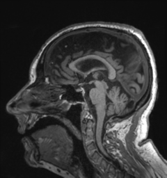 Behavioral variant frontotemporal dementia and late onset schizophrenia (Radiopaedia 52197-58083 Sagittal T1 47).png