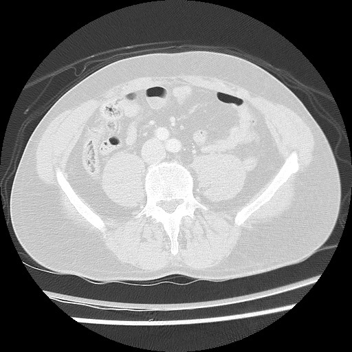 Benign post-traumatic pseudopneumoperitoneum (Radiopaedia 71199-81495 Axial lung window 103).jpg