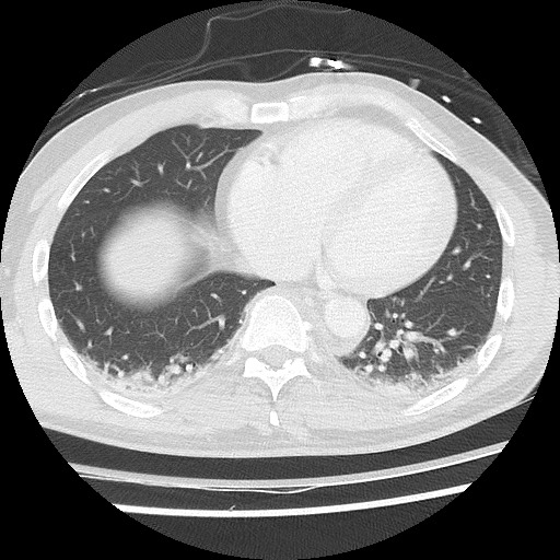 Benign post-traumatic pseudopneumoperitoneum (Radiopaedia 71199-81495 Axial lung window 50).jpg