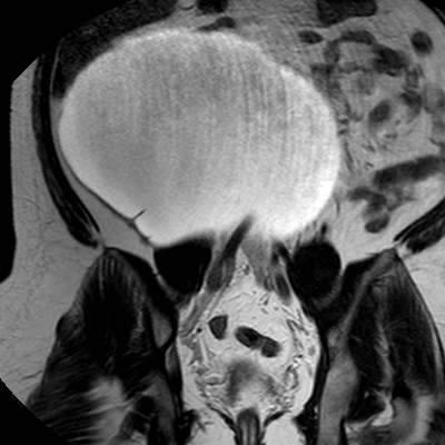 File:Benign seromucinous cystadenoma of the ovary (Radiopaedia 71065-81300 F 18).jpg
