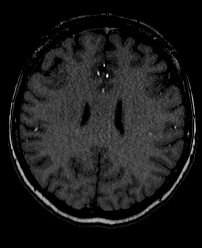File:Berry aneurysm of the terminal internal carotid artery (Radiopaedia 88286-104918 Axial TOF 154).jpg