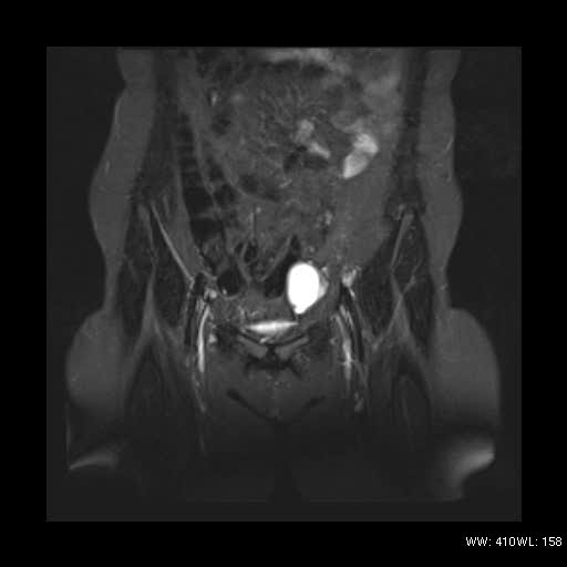 File:Bicornuate uterus- on MRI (Radiopaedia 49206-54297 Coronal STIR 3).jpg